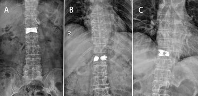 Effects of distribution of bone cement on clinical efficacy and secondary fracture after percutaneous kyphoplasty for osteoporotic vertebral compression fractures